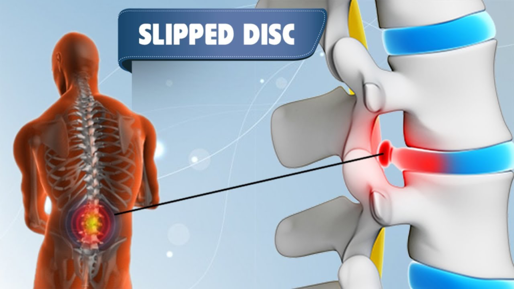 Slipped Disc Cause Abdominal Pain