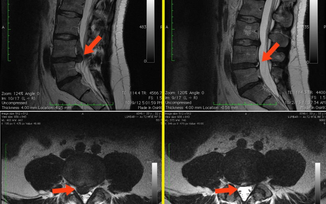 The Stable Spine Series Part 4: X-Rays, MRI’s…Dangerous for a Bad Back?